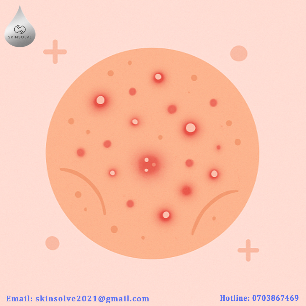 Bí quyết làn da sạch mụn tuổi dậy thì: Khám phá bộ sản phẩm Skinsolve được chuyên gia khuyên dùng