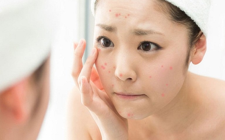 Liệu trình trị mụn chuẩn y khoa tại Skinsolve – Giải pháp loại bỏ mụn tận gốc