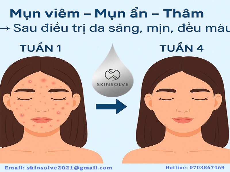 Liệu trình trị mụn chuẩn y khoa tại Skinsolve – Giải pháp loại bỏ mụn tận gốc