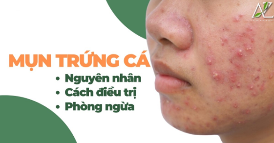 Các nguyên nhân gây ra mụn trứng cá
