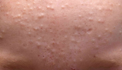 Các loại mụn lưng thường gặp