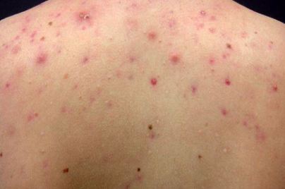 Các loại mụn lưng thường gặp