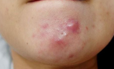 Các loại mụn lưng thường gặp