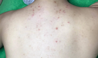 Các loại mụn lưng thường gặp