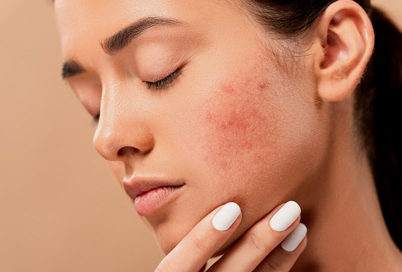 Nguyên nhân phổ biến gây mụn kích ứng ở da nhạy cảm