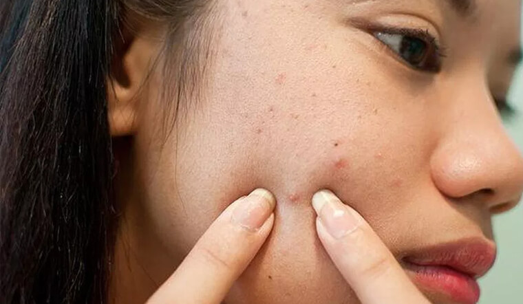 Cách xử lý mụn kích ứng an toàn tại nhà
