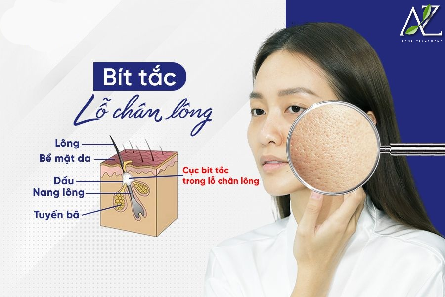 Nguyên Nhân Gây Mụn Đầu Đen