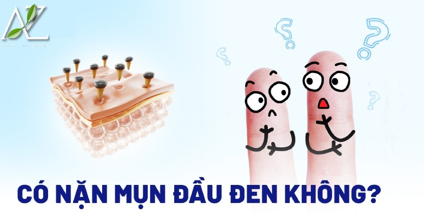 Cách Nặn Mụn Đầu Đen An Toàn Tại Nhà