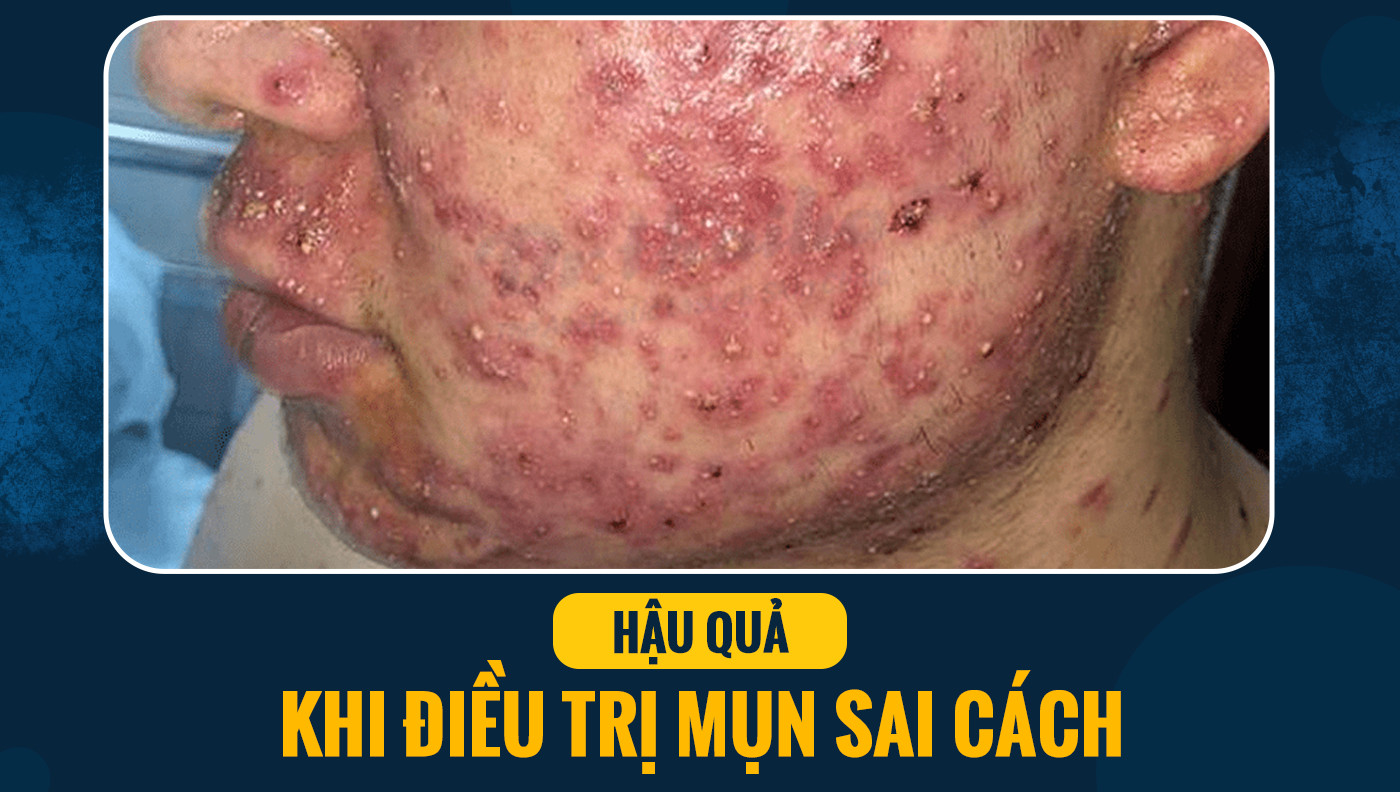 Mụn Đầu Đen Có Nên Lấy Không