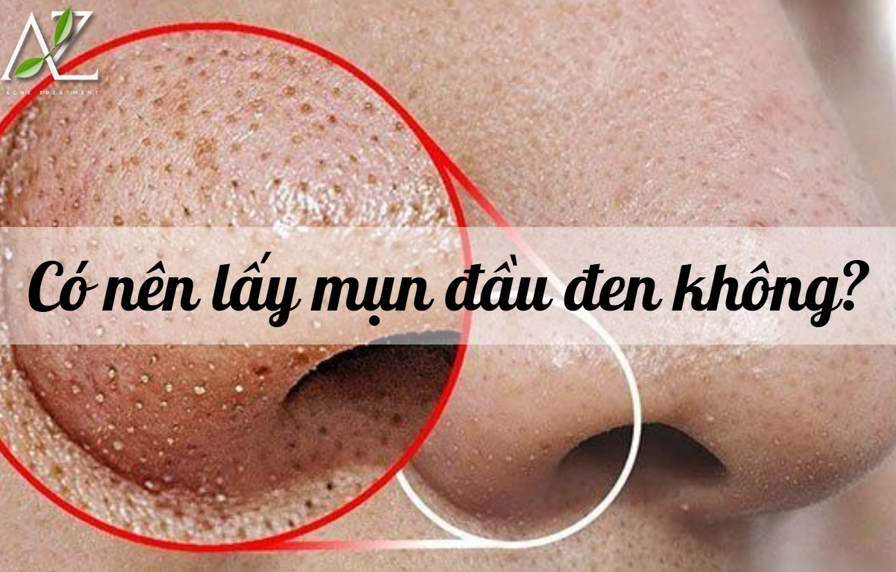Mụn Đầu Đen Có Nên Lấy Không