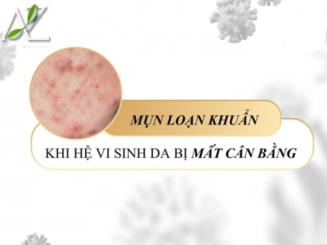 Vì Sao Mẹ Bầu Dễ Nổi Mụn?