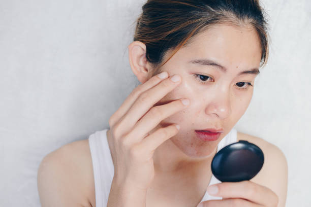 Da dầu, mụn và kem chống nắng: Bí quyết chọn đúng để không phản tác dụng