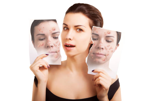 Bí Quyết Phục Hồi Làn Da Sau Mụn Với Các Hoạt Chất Dịu Nhẹ Mà Bạn Chưa Từng Biết