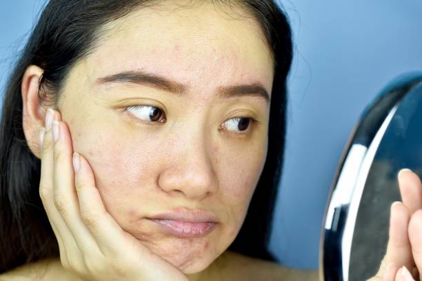 Vì sao lỗ chân lông ngày càng to? Hiểu đúng để chăm da đúng cách