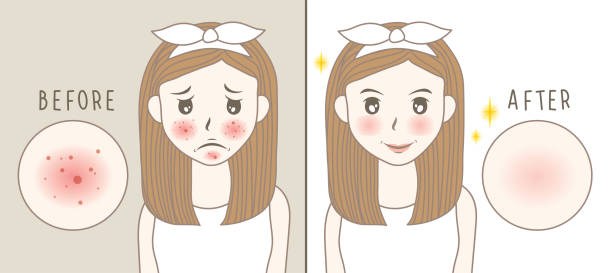 Bí Quyết Phục Hồi Làn Da Sau Mụn Với Các Hoạt Chất Dịu Nhẹ Mà Bạn Chưa Từng Biết