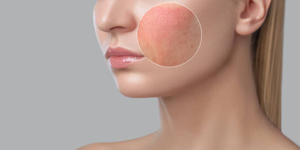 5 giải pháp từ thiên nhiên giúp thu nhỏ lỗ chân lông không cần spa