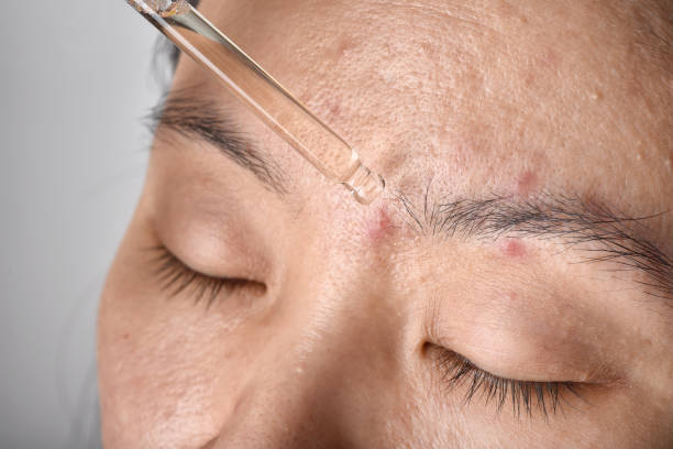 Da Dầu Có Cần Dưỡng Ẩm Không ? 7 Sự Thật Sẽ Khiến Bạn Muốn Biết