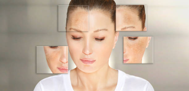 Làm sao phân biệt nám và tàn nhang để điều trị hiệu quả ?