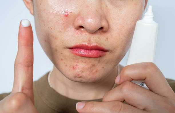 Bí kíp chọn serum phù hợp từng loại da – Không còn lo kích ứng hay nổi mụn