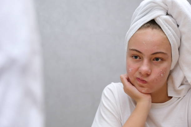 Chăm da mụn đúng cách – Không kích ứng, không tái phát
