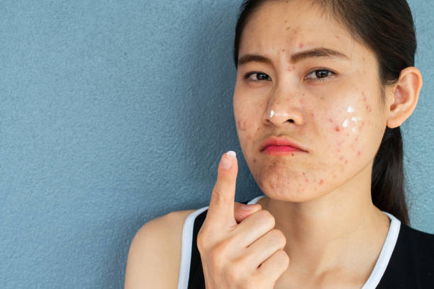 Vì Sao Kem Chống Nắng Lại Cực Kỳ Quan Trọng Với Da Mụn ?