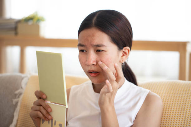 Da dầu mùa hè không còn đáng sợ nếu bạn biết 7 bí kíp kiểm soát bã nhờn này