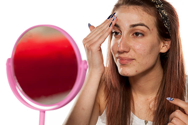 Da dầu mùa hè không còn đáng sợ nếu bạn biết 7 bí kíp kiểm soát bã nhờn này
