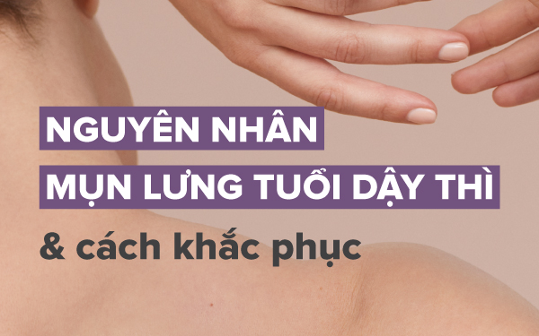 Mụn Lưng Ở Tuổi Dậy Thì: Cách Nhận Biết, Điều Trị Và Phòng Ngừa Hiệu Quả