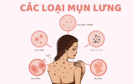Các loại mụn lưng thường gặp