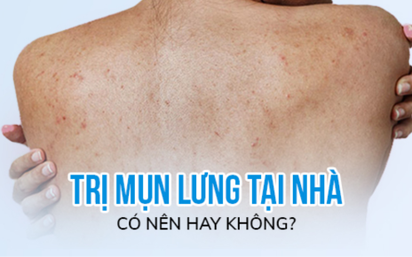 Cách trị mụn lưng hiệu quả tại nhà